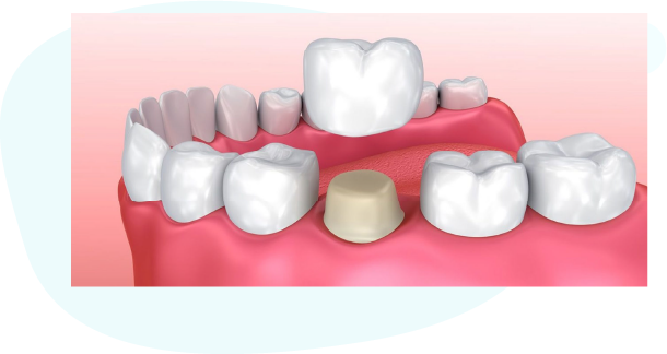 Custom Tooth Crowns in Katy​